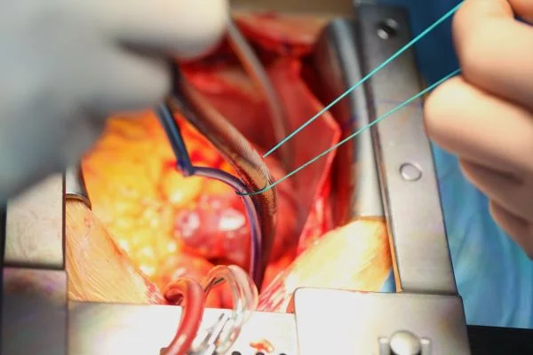 cardiac-surgery