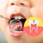 Explaining Tooth Cavity Dental Filling in Dwarka