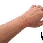 How to cure skin hives fast? | Skin Specialist in Gurgaon
