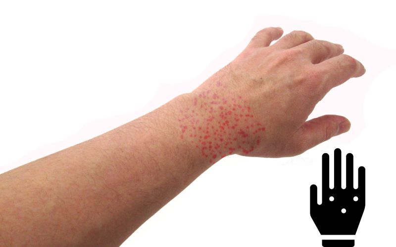 How to cure skin hives fast? | Skin Specialist in Gurgaon