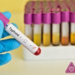 Is Typhoid contagious? Typhoid Specialist in Delhi NCR